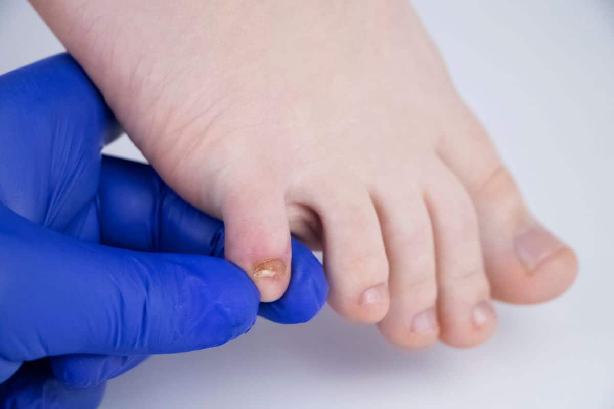 Como evitar a micose nas unhas (das mãos e pés)? Veja 5 cuidados indispensáveis 1 micose nas unhas dos pés