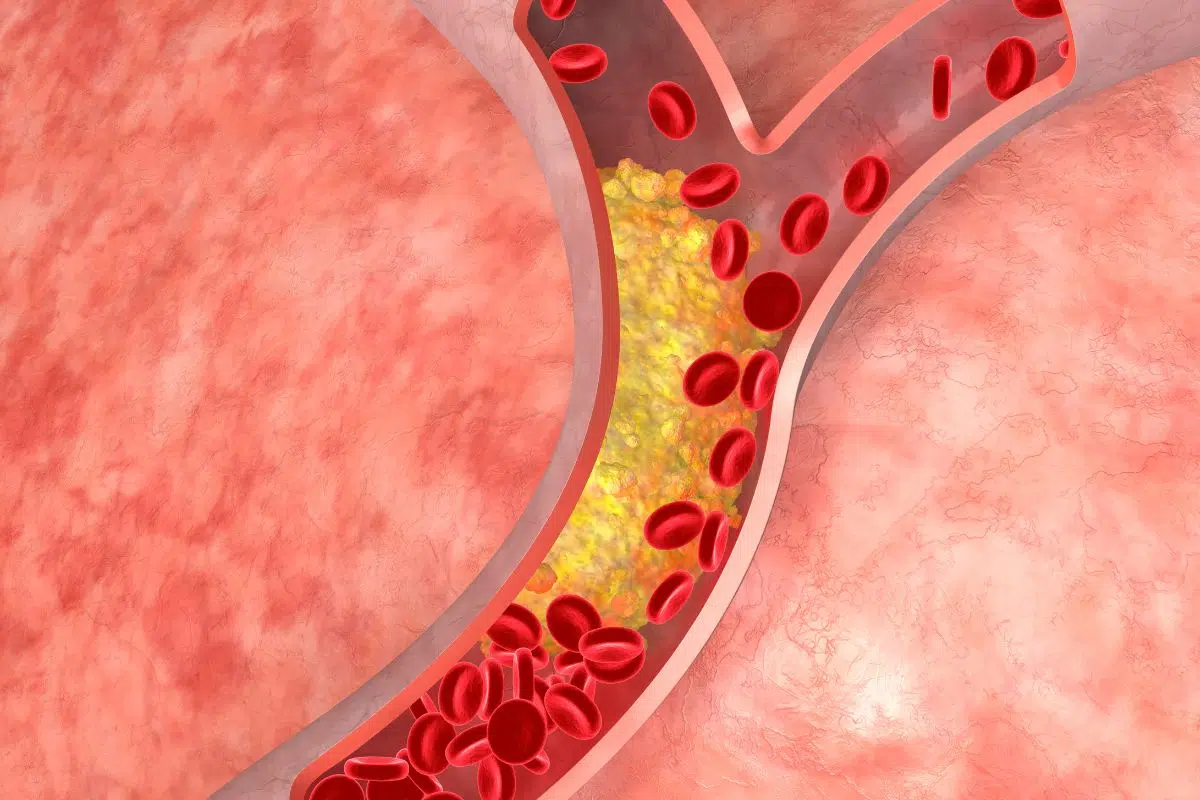 Descubra o que o colesterol alto pode causar no corpo