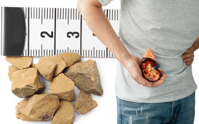 Pedra no rim: o que causa, onde dói e como prevenir o cálculo renal 1 Pedra no rim