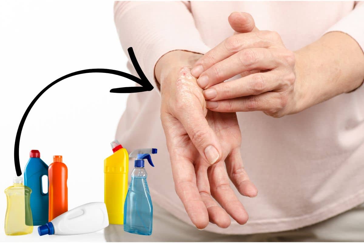 Tem alergia ao detergente? Veja como substituir e manter a limpeza sem dor 1 mulher alergia de detergente na mão