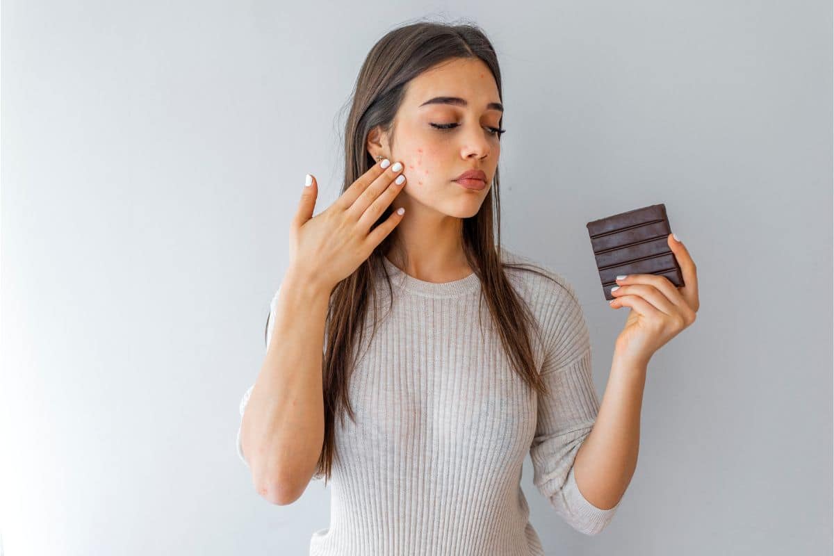 comer chocolate pode causar acne