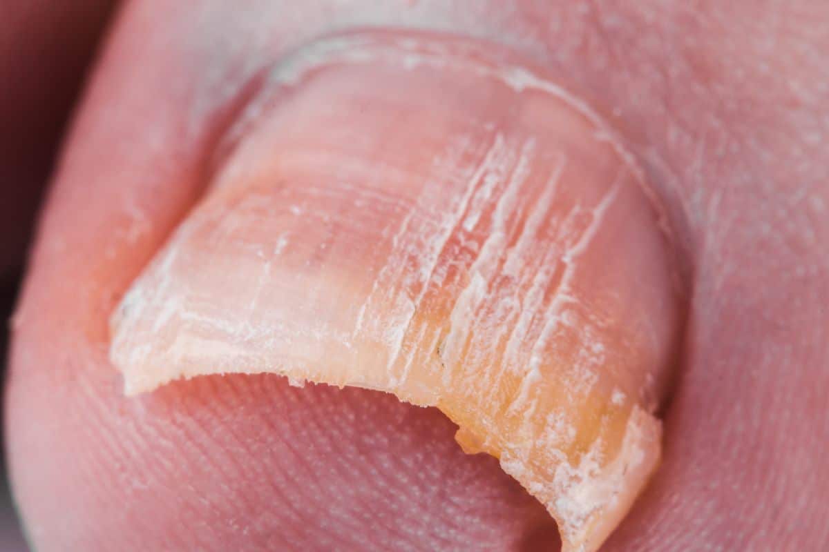 micose nas unhas é transmissível