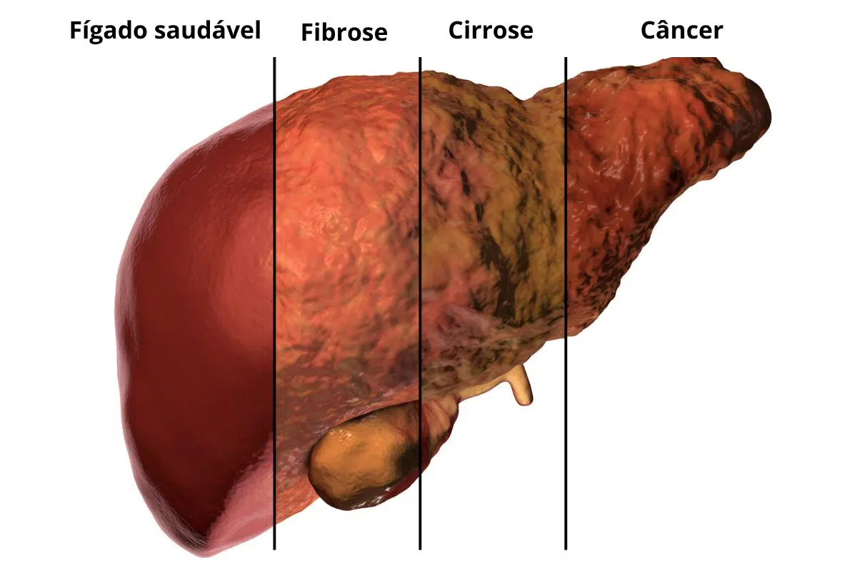 primeiros sintomas de gordura no fígado e sua evolução