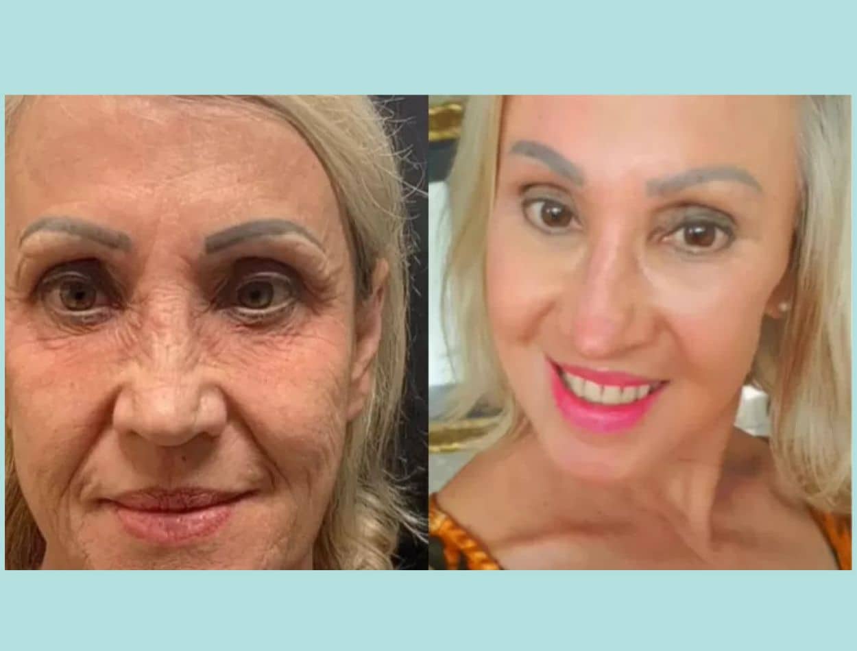 Une femme âgée change de peau après une intervention esthétique et élimine les rides SaúdeLab