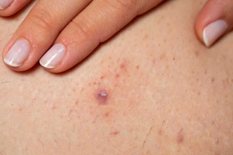 pelos encravados na perna