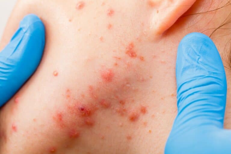 Quando suspeitar de puberdade precoce? É importante ficar atento aos sinais 4 acne na puberdade precoce