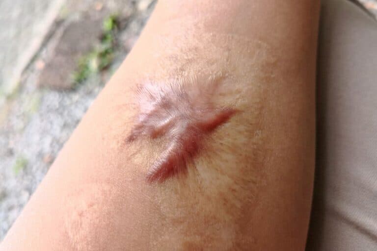 cicatriz - queloide pós queimadura