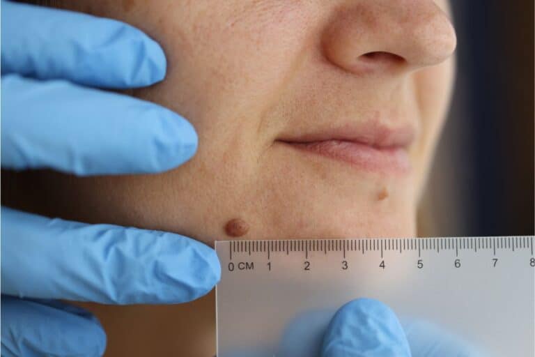 Quando as verrugas são perigosas? Por que elas surgem? Quais os tipos? Entenda já 1 avaliação médica de verrugas