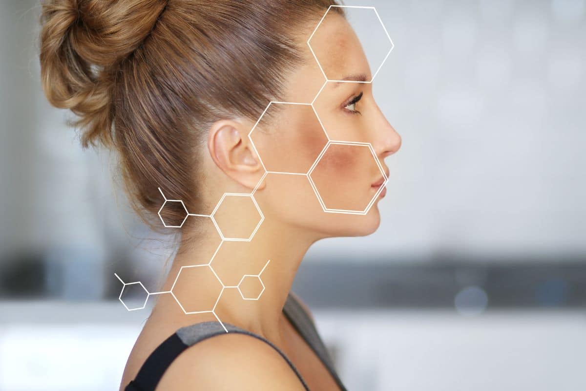 O que é melasma? Quais as causas comuns? Entenda 1 O que é melasma