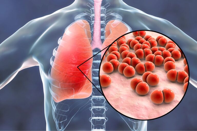 Quais os sintomas de pneumonia? Entenda todos os sinais do problema respiratório 1 Quais os sintomas de pneumonia