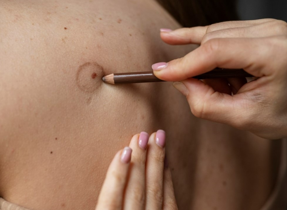 Dezembro Laranja e a prevenção do câncer de pele: o tumor de maior incidência no Brasil