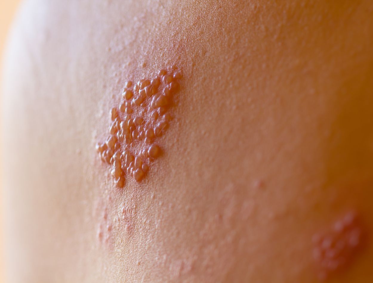 Arlete Sales teve câncer de mama, mas hoje sofre com outro problema de saúde: herpes-zoster 2 lesões de herpes-zoster