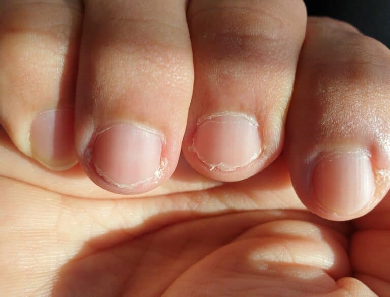 Pelinhas nas unhas e onicofose: o que causa e como evitar que apareçam 3 Pelinhas nas unhas e onicofose