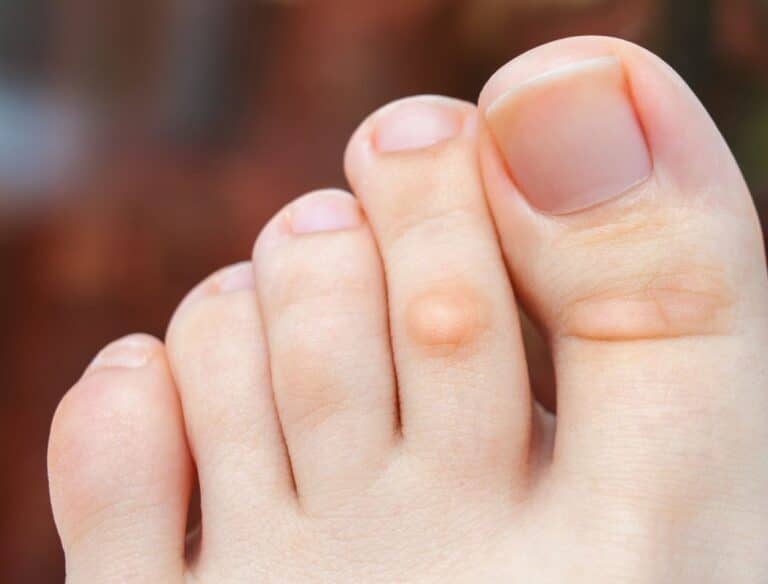 Como fazer um removedor de calos caseiro? Aprenda o passo a passo 5 Como fazer um removedor de calos caseiro