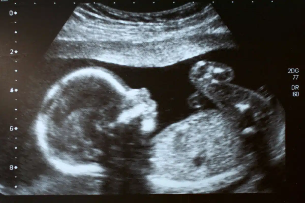 imagem de ultrassom morfológico