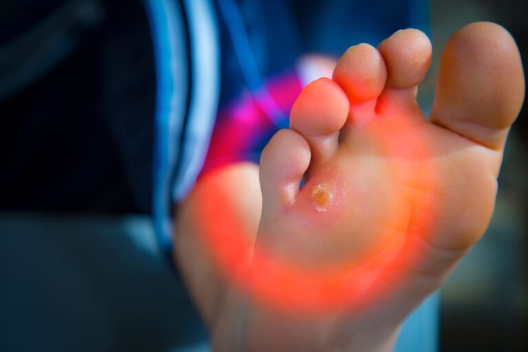 Como evitar e remover calos no pé