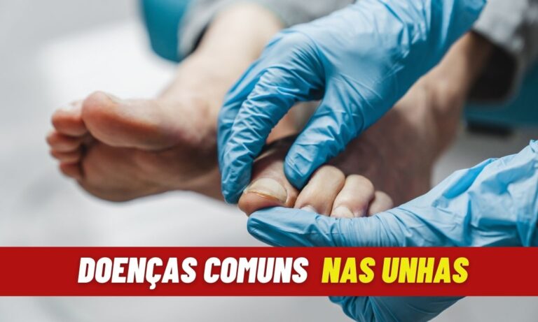 Conheça 7 doenças de unhas mais comuns e como evitá-las 6 Doenças Comuns nas Unhas.