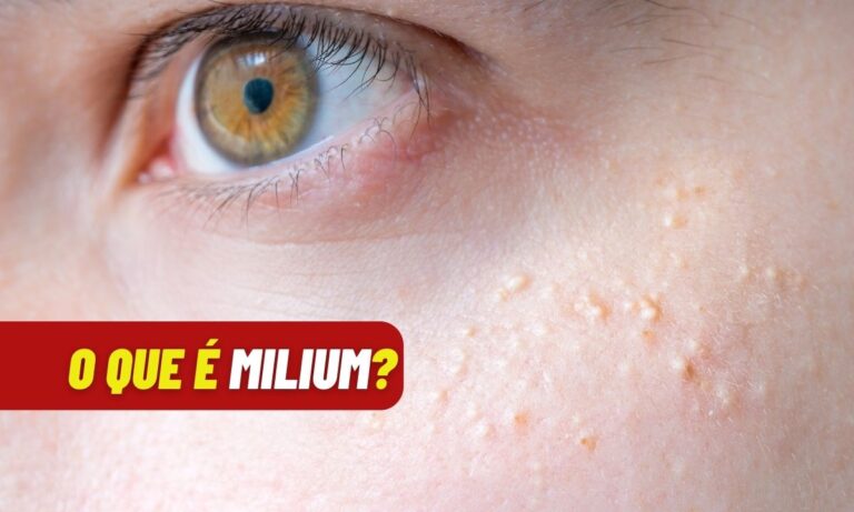 O que causa Milium na pele? É sinal de problemas de saúde? Entenda 1 Milium