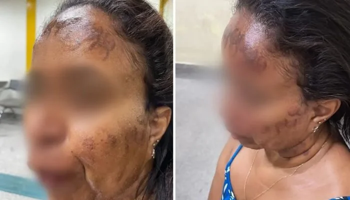Mulher com rosto queimado após laser