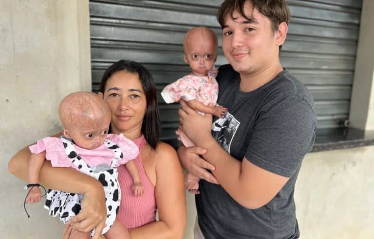 Envelhecimento Precoce: mãe de gêmeas que sofre dessa condição luta pela vida das filhas 5 Envelhecimento precoce.