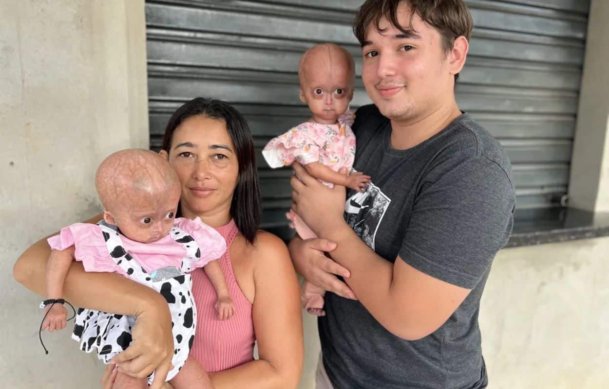 Envelhecimento Precoce: mãe de gêmeas que sofre dessa condição luta pela vida das filhas 1 Envelhecimento precoce.