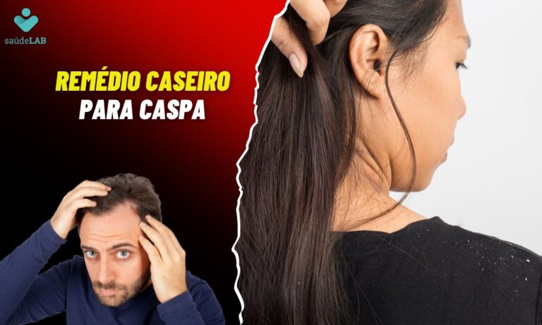 Remédio Caseiro para Caspa: saiba como resolver o problema de maneira simples 4 Remédio caseiro para caspa.