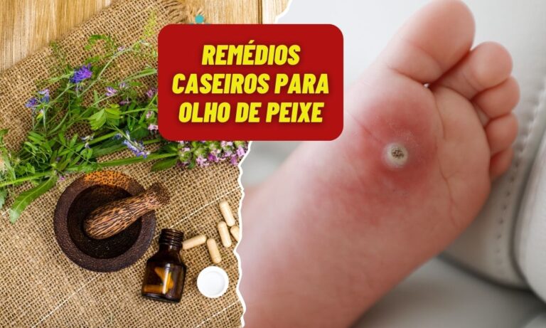 Remédio caseiro para olho de peixe: aprenda 05 dicas para aliviar o desconforto 7 Remédio Caseiro para olho de peixe.