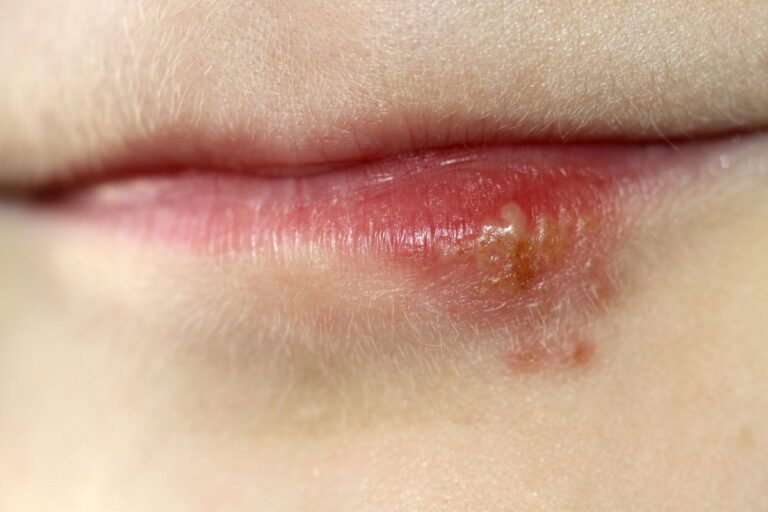 Quanto tempo dura herpes labial? Saiba os cuidados que você precisa ter 1 Quanto tempo dura herpes labial
