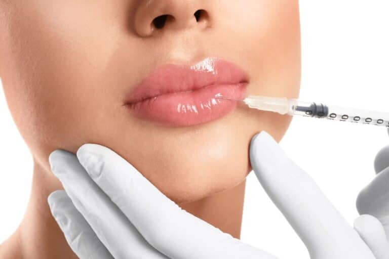 Quanto tempo dura o preenchimento labial? Descubra e saiba se vale a pena 1 Quanto tempo dura o preenchimento labial