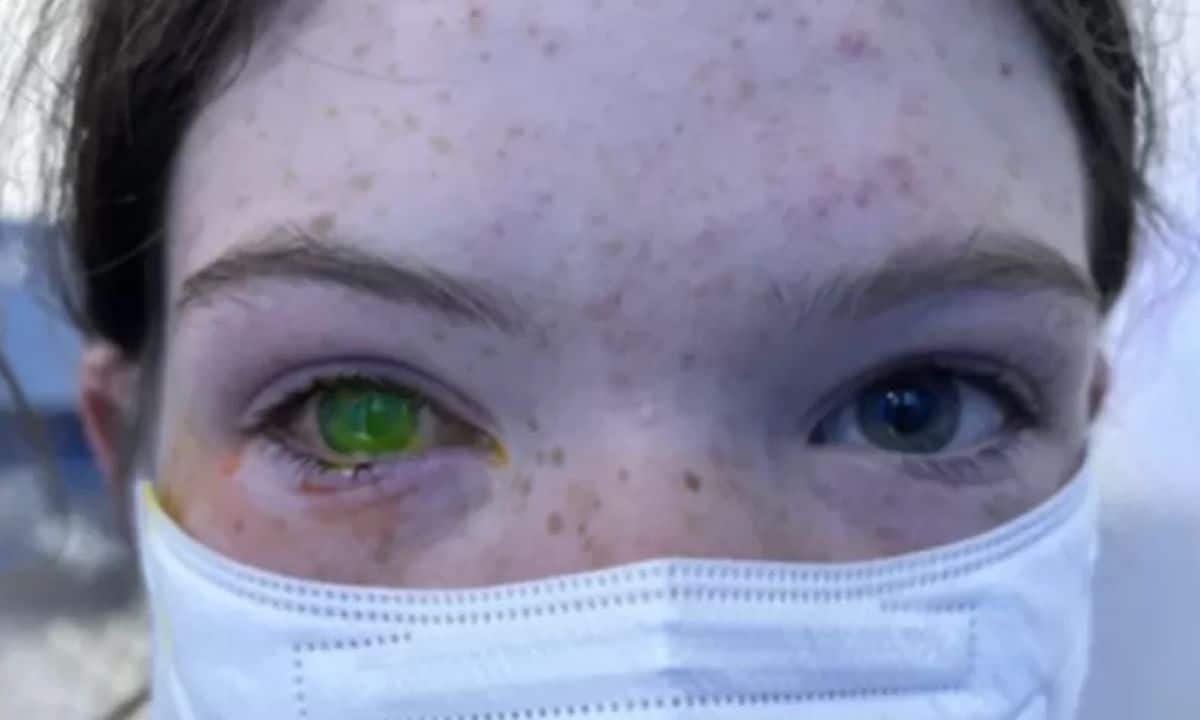 Doença do olho esverdeado.
