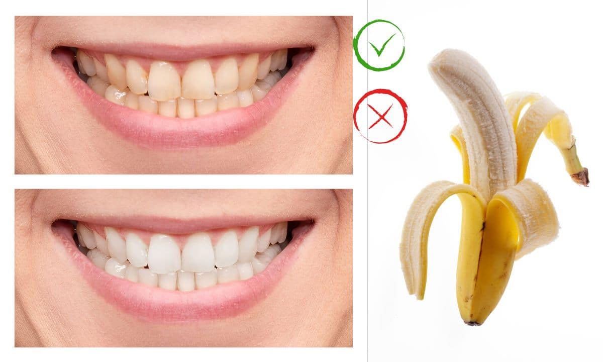 Casca de banana clareia os dentes?