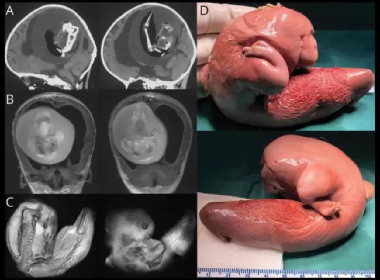 Bebê de 1 ano realiza cirurgia para retirar cérebro feto de irmão gêmeo