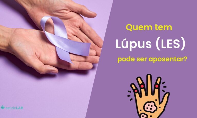 Lúpus dá direito à aposentadoria do INSS? Entenda as condições assistidas 1 Lúpus dá direito à aposentadoria.