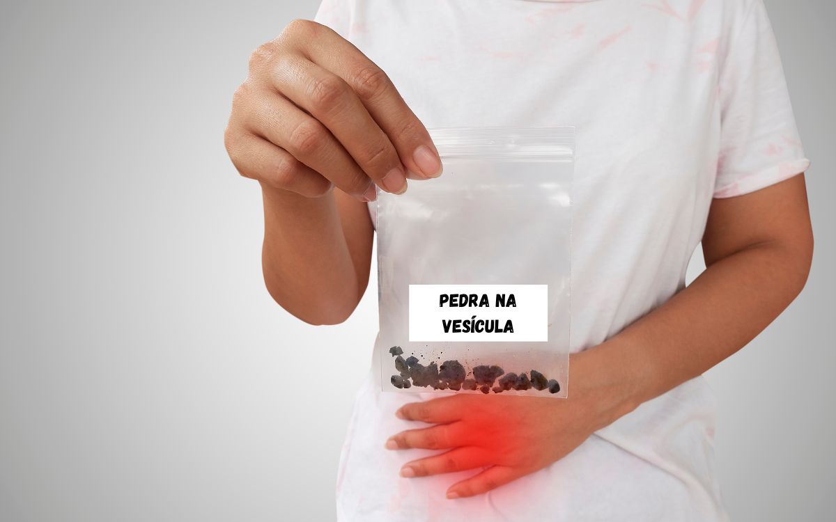 Quem tem pedra na vesícula pode comer ovo? 