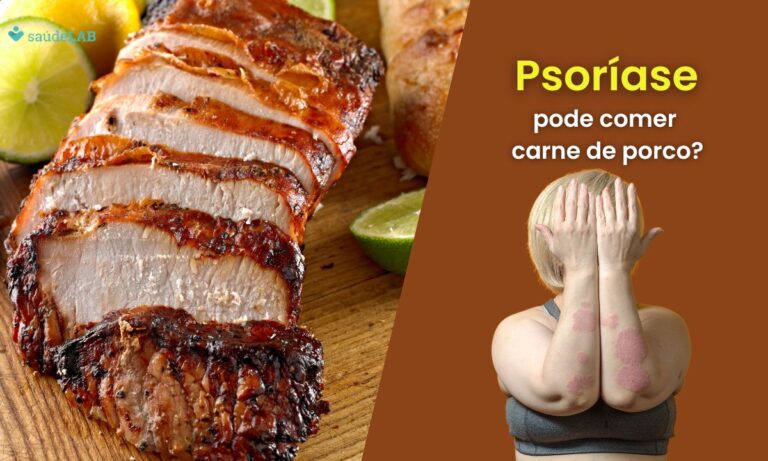 Quem tem psoríase pode comer carne de porco? Entenda as restrições alimentares da doença 6 Quem tem psoríase pode comer carne de porco.