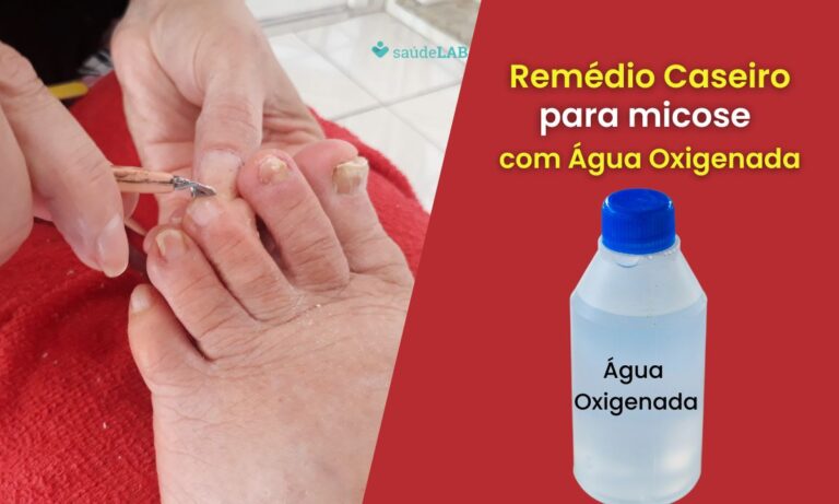 Remédio caseiro para micose de unha com água oxigenada.