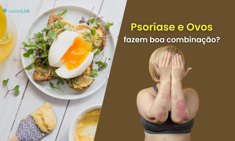 Quem tem psoríase pode comer ovo