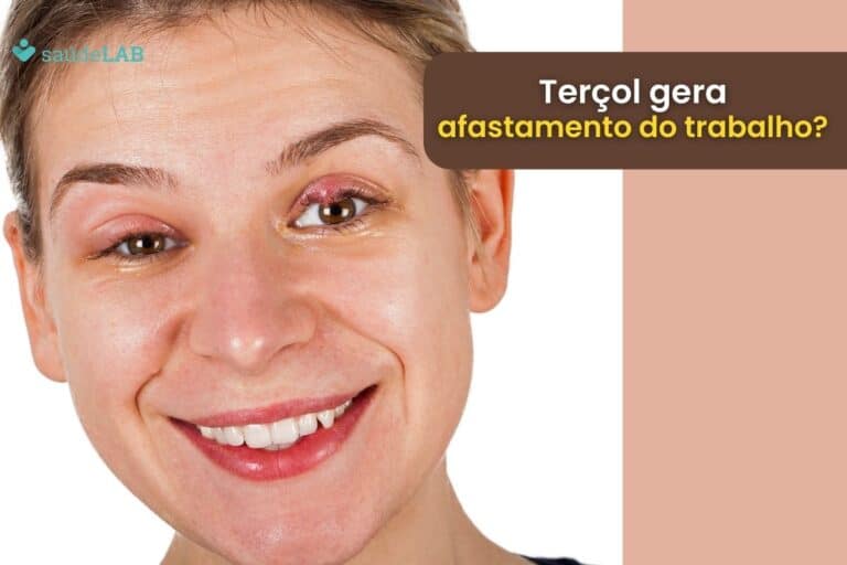 Terçol dá atestado? Entenda se a condição pode gerar afastamento do trabalho 3 Terçol dá atestado.