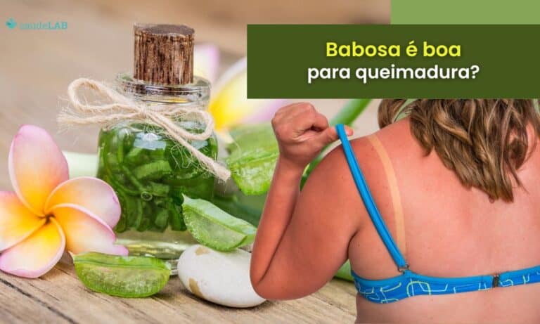 Babosa é boa para queimadura.