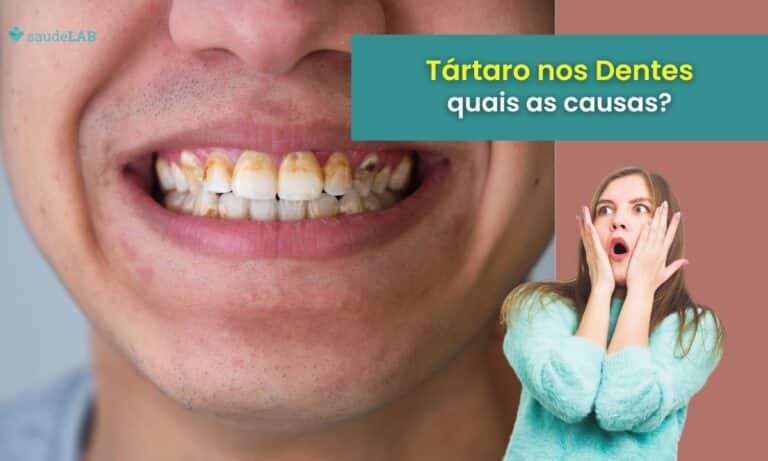 O que causa tártaro nos dentes? Descubra como evitar e tratar esse problema 3 O que causa tártaro nos dentes.