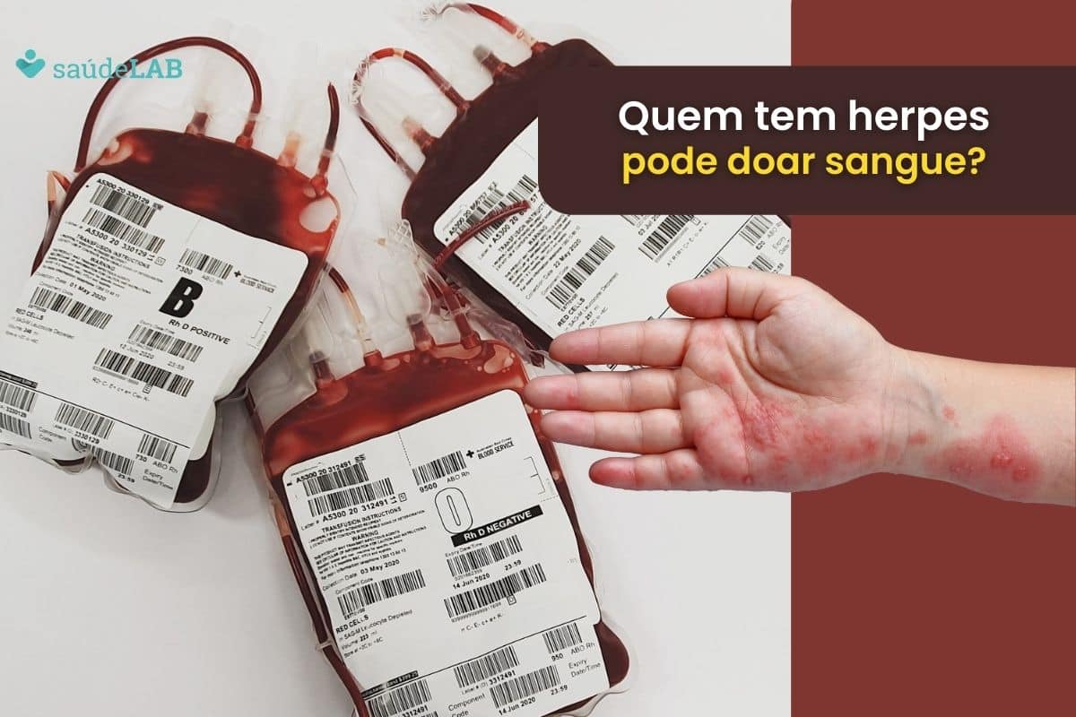 Quem tem herpes pode doar sangue? Saiba se existe alguma relação 1 Quem tem herpes pode doar sangue.
