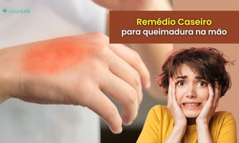 Remédio Caseiro para Queimadura na Mão: confira dicas poderosas para cuidar em casa 3 Remédio caseiro para queimadura na mão.