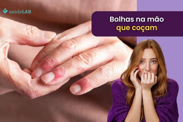 bolhas na mão que coçam.