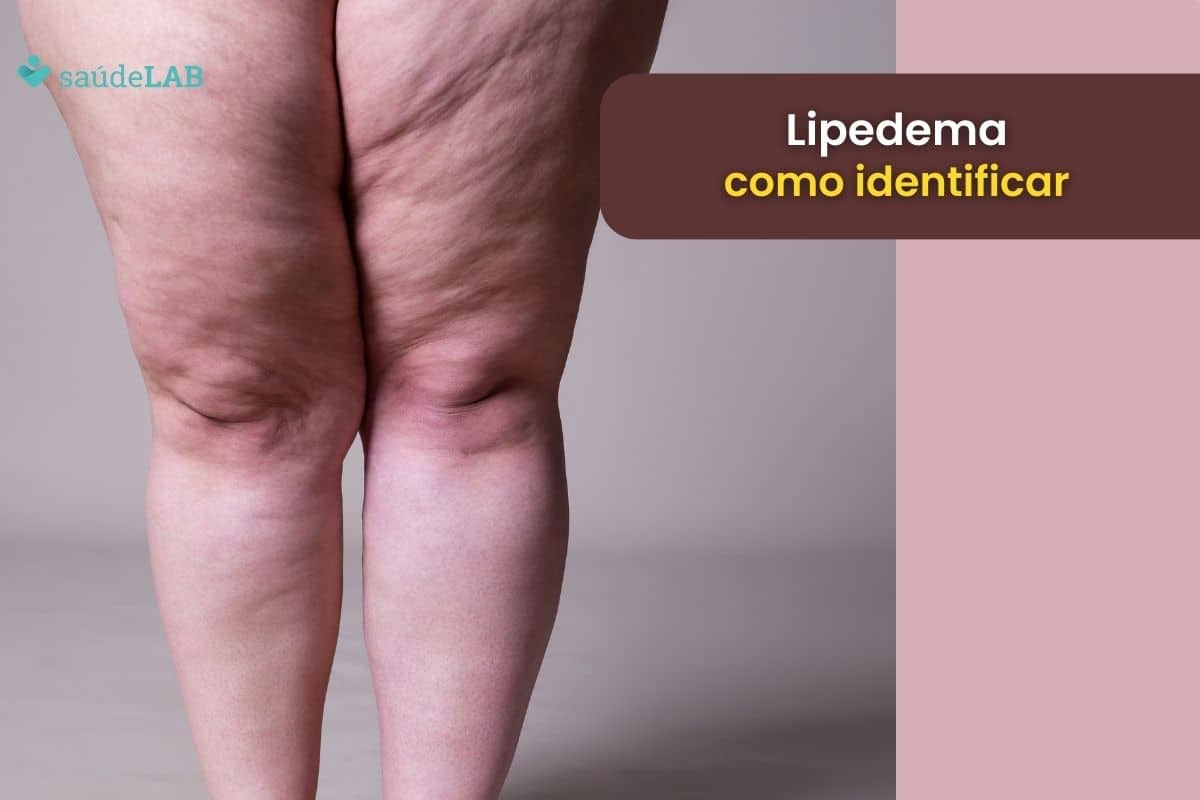 Lipedema – Excesso de gordura localizada pode ser sinal de