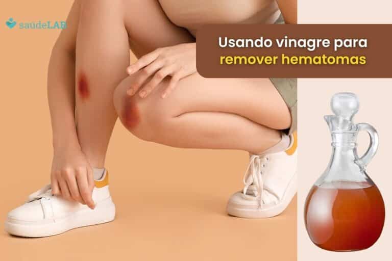 Como tirar roxo da pele com vinagre.