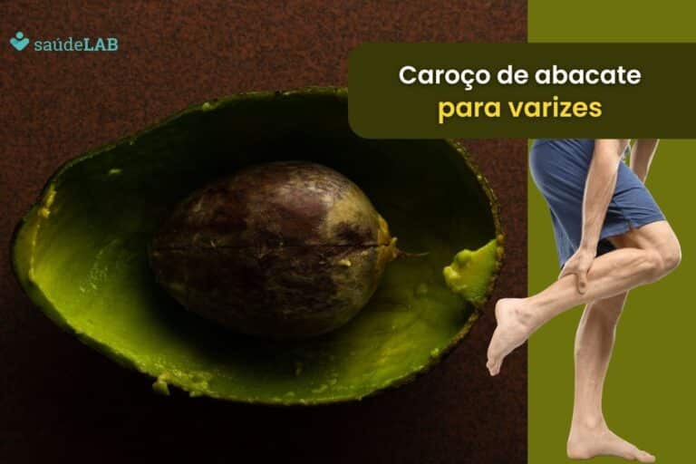 Caroço de abacate no álcool para varizes funciona mesmo? Saiba mais 2 caroço de abacate no álcool para varizes.