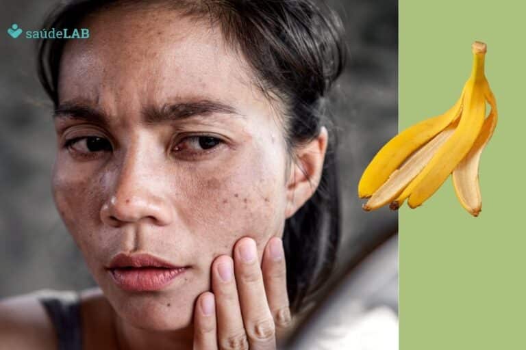 Passar casca de banana no rosto tira manchas da pele? Será que é perigoso? Entenda 3 passar casca de banana no rosto tira manchas.