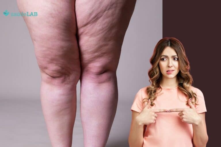 Lipedema: quais os sintomas e tratamentos? Tire sua dúvidas 3 lipedema.