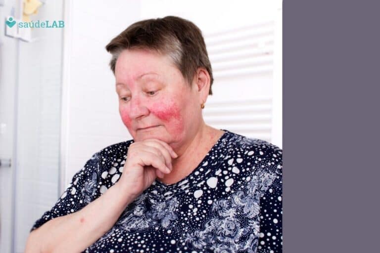 O que é rosácea: entenda os detalhes e tratamentos disponíveis 2 Mulher com rosácea.