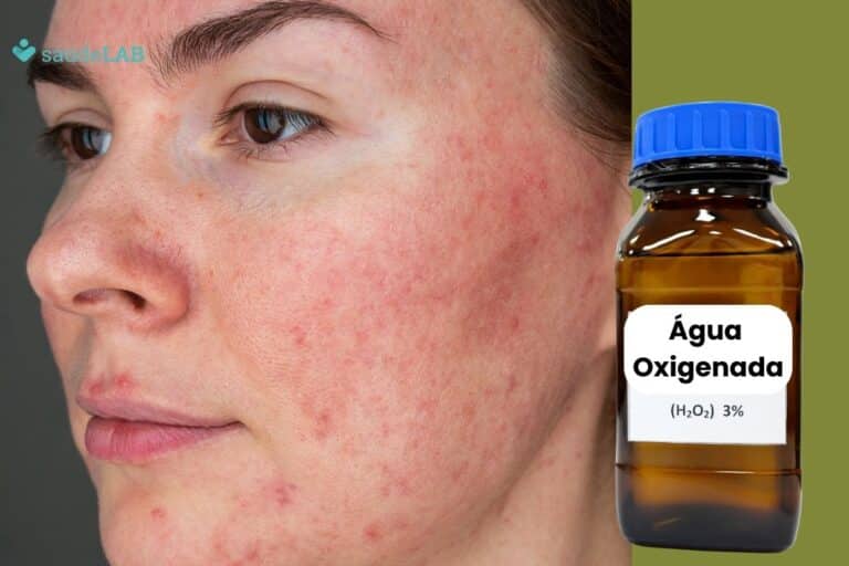 Rosácea tem cura definitiva com água oxigenada mesmo? Entenda 5 rosácea cura definitiva com água oxigenada.